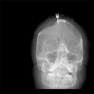 What a post-surgery hit-and-ran skull looks like