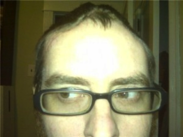 This is what my skull looked like for a few months after getting hit-and-run.
